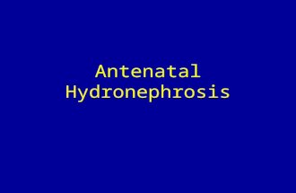 Antenatal Hydronephrosis. Definition: AP diameter renal pelvis > 4mm @ 20 wk EGA AP diameter renal pelvis > 7mm @ 30 wk EGA Incidence: 5% of pregnancies.