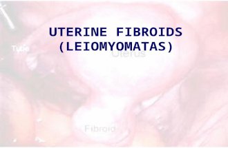 UTERINE FIBROIDS (LEIOMYOMATAS). Smooth Muscle Tumor of the Uterus The most common uterine tumor –Occurring in about 30% of women above the age of 30.