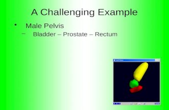 A Challenging Example Male Pelvis –Bladder – Prostate – Rectum.