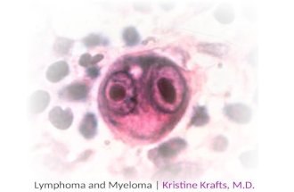 Lymphoma and Myeloma |  Kristine Krafts, M.D.
