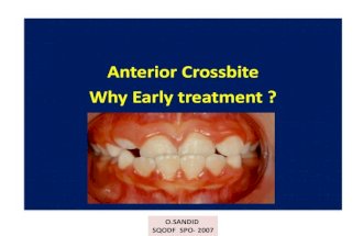 Anterior crossbite  early treatment in orthodontic  -o sandid -oussama sandid orthodontist