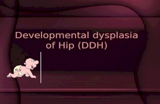 Developmental dysplasia of Hip (DDH)