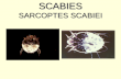 Scabies ppt