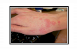 Scabies home treatment signs of scabies, picture of scabies